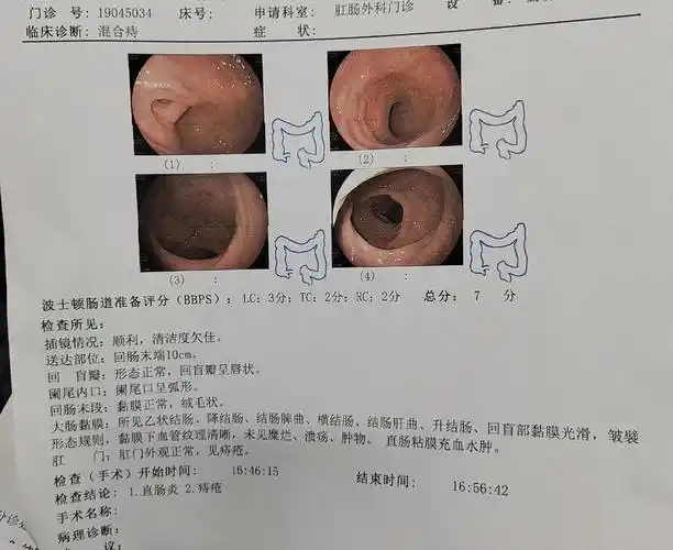 肠镜全过程,没有打麻药,肠子都悔青了,感觉就像经历分娩般痛!