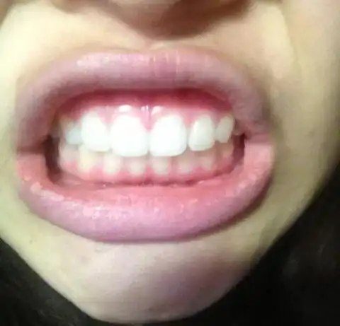 请问我这样的牙槽突出需要手术吗?该如何解