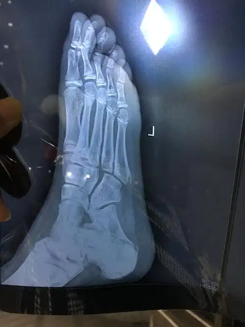 孩子11岁,崴脚脚骨折5天了,肿有淤血,不动不疼,走路就脚酸.