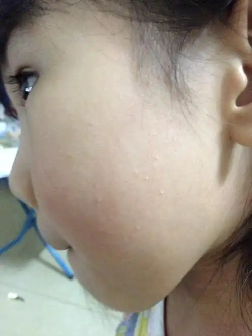 宝妈们帮我看看我女儿脸上这些小点点是什么