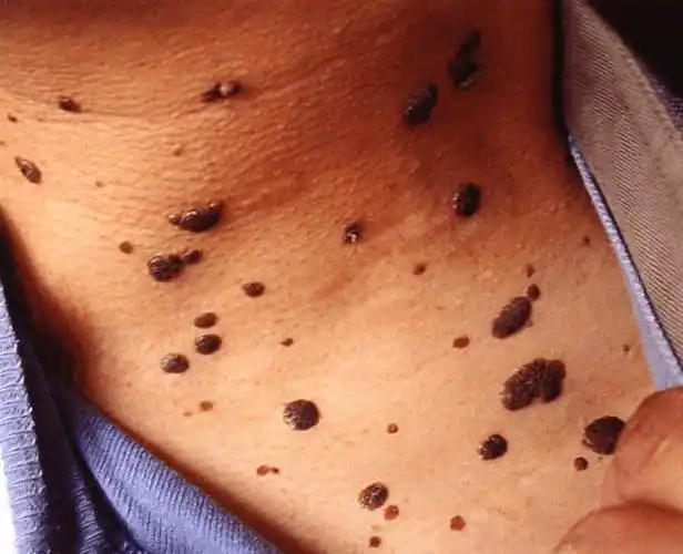 丽医科普丨年纪轻轻为什么会长老年斑