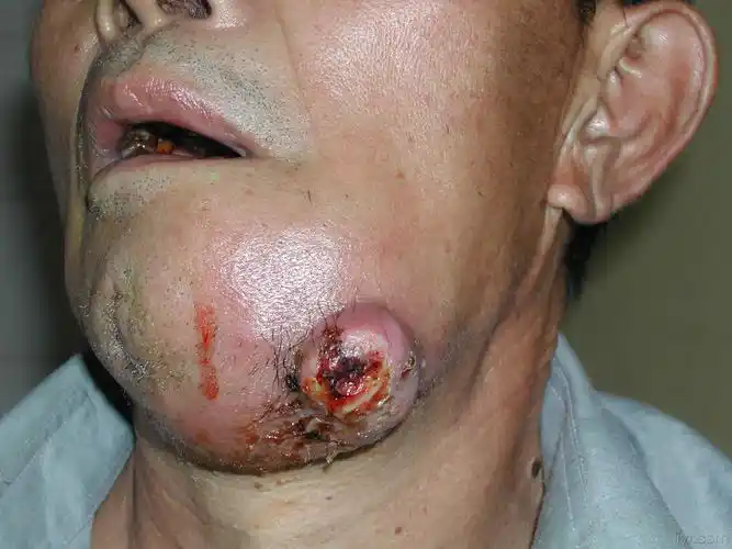 牙龈癌手术前后图