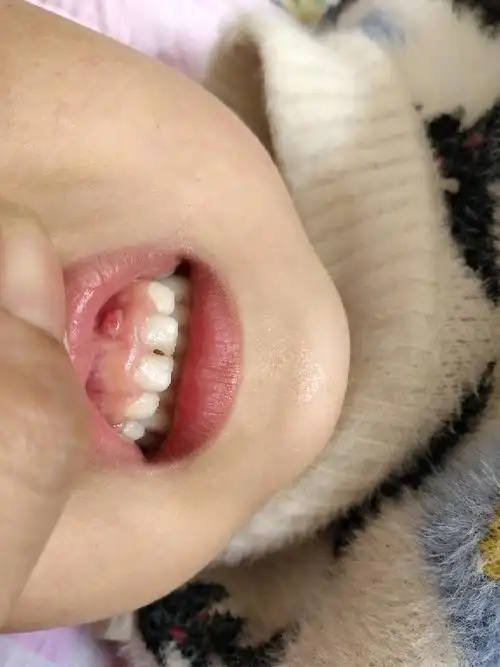 大儿子牙龈长了一个疙瘩怎么回事