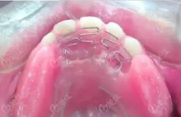 儿童地包天矫正器是什么样子的求反颌矫正器种类及图片