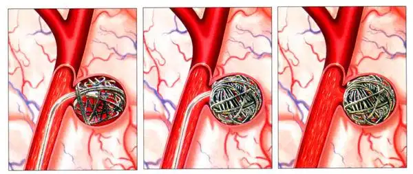 燕化医院神经外科开展多项颅脑介入术