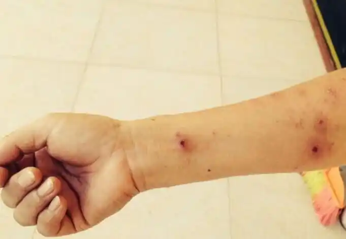 两天周末,更大的奇迹出现了,我被叮咬的地方不流黄水了,伤口也痊愈了