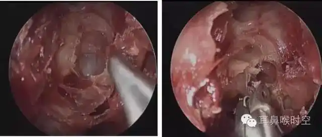 基础必备丨鼻内镜鼻窦手术的操作过程详解
