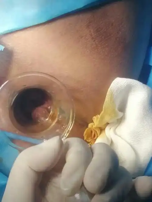 我科首例直肠粘膜内脱垂,应用微创套扎,顺利完成.