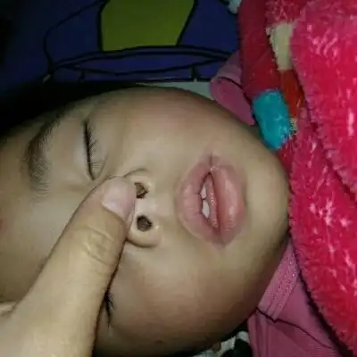 宝宝鼻息肉是什么原因引起的