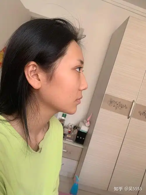 这样的鼻基底凹陷怎么办