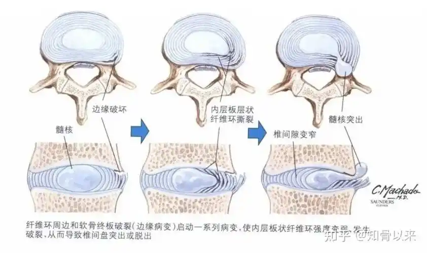 腰椎间盘膨出是不是病