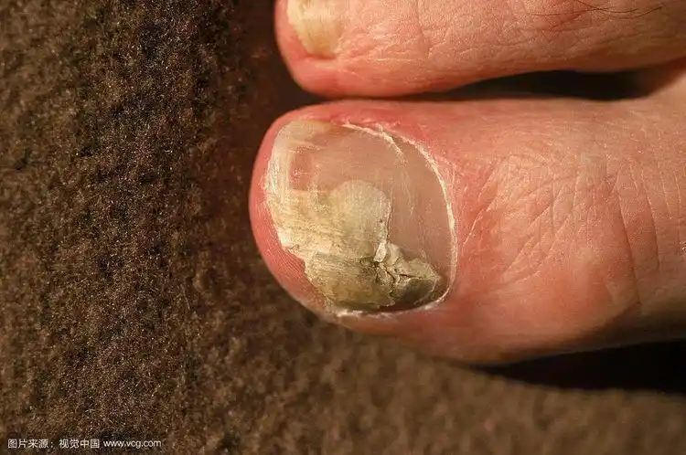 灰指甲有哪些症状表现?预防灰指甲传染注意5点