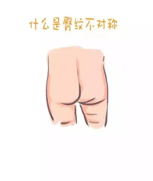 宝宝臀纹不对称,在家如何检查髋关节发育异常