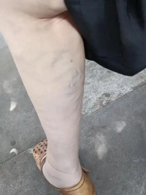 技术是一种新兴的治疗静脉曲张的微创技术,其可以明显改善曲张症状