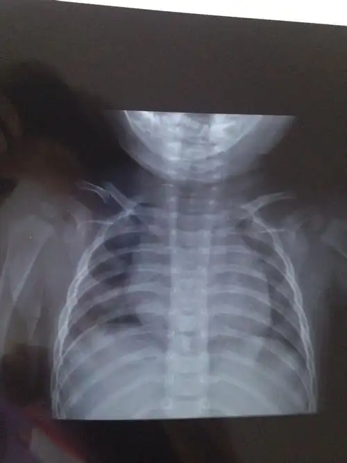 宝宝7个月锁骨骨折了,大夫说不用绷带固定,让自然生长,会有什么影响吗