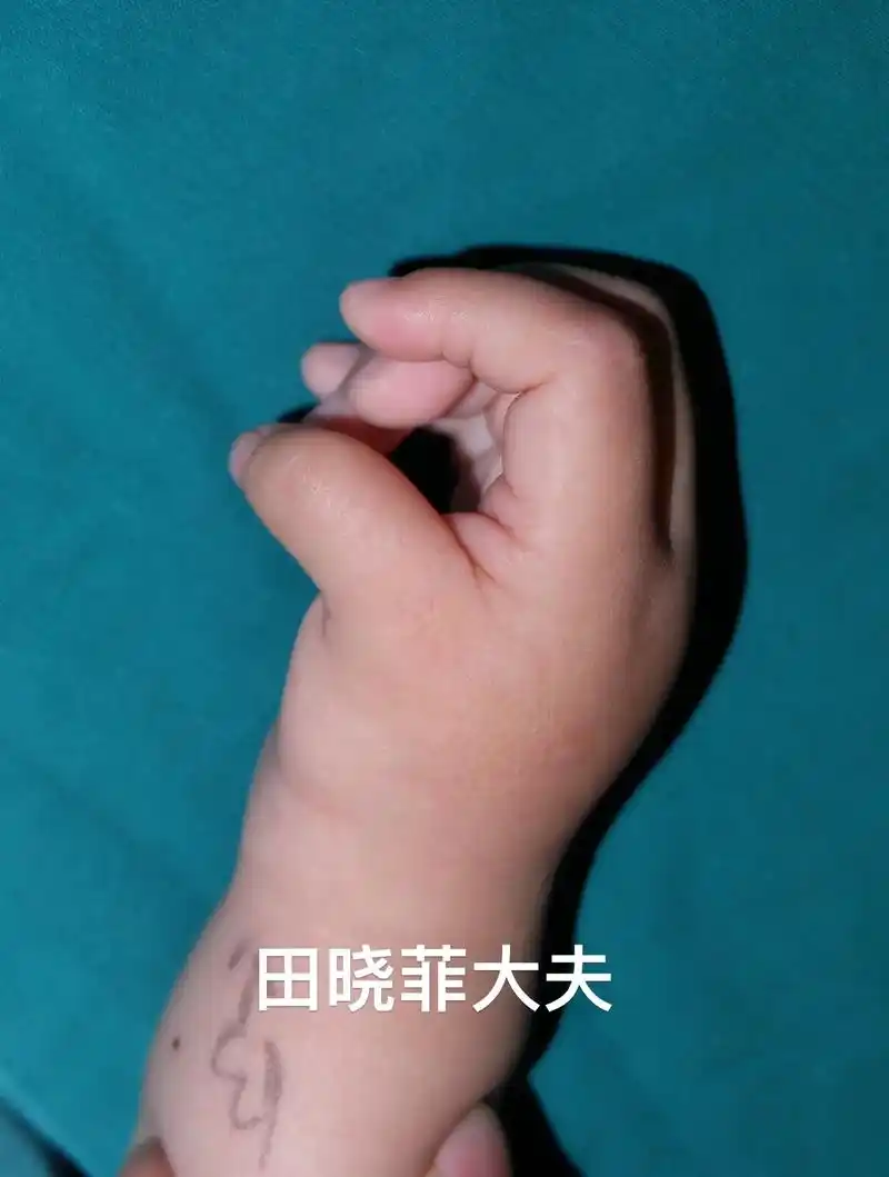 先天性拇指发育不良.患儿,男,2岁5个月,因出生后右手拇指偏 - 抖音