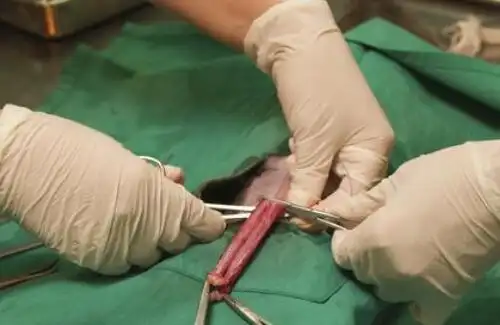 男人结扎对身体有什么影响 男人结扎需要多少钱_婚庆知识_婚庆百科_齐