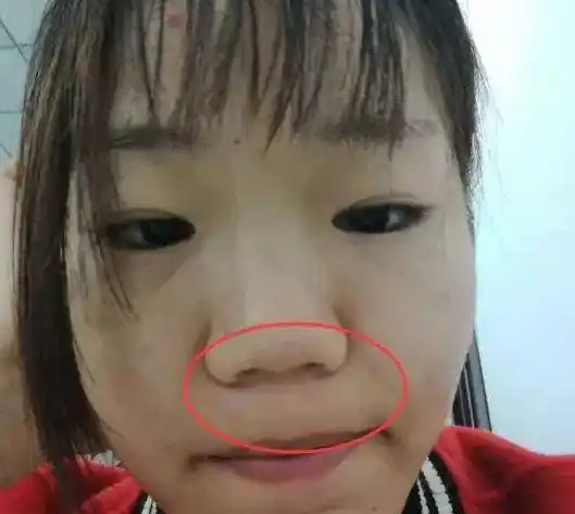 这3种行为等于"慢性毁鼻",初中生若不当回事,迟早会越变越丑_鼻子