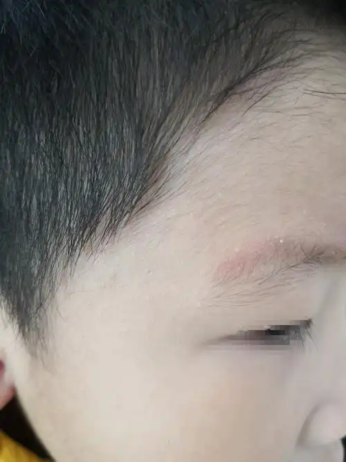 宝宝脸上长的密密麻麻的小疙瘩是什么