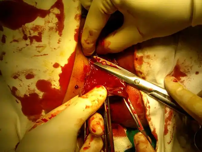 pph 嵌顿痔外痔部分环切,图片如下,欢迎大家讨论指导!