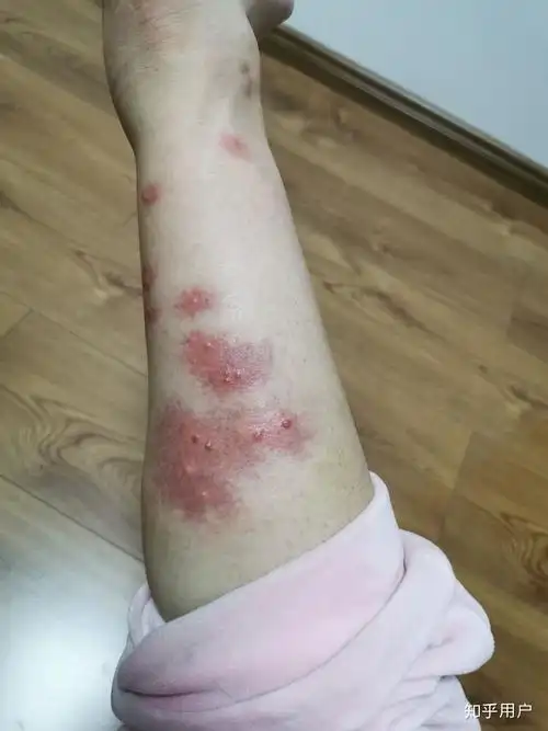 被臭虫咬是一种什么样的体验