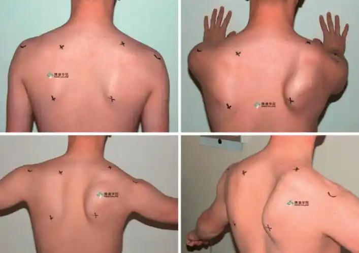 翼状肩原因分析汇总