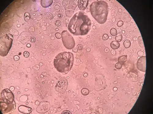 病例小分享 写美篇粪便淀粉颗粒介绍: 粪便淀粉颗粒,是粪便显微镜检查