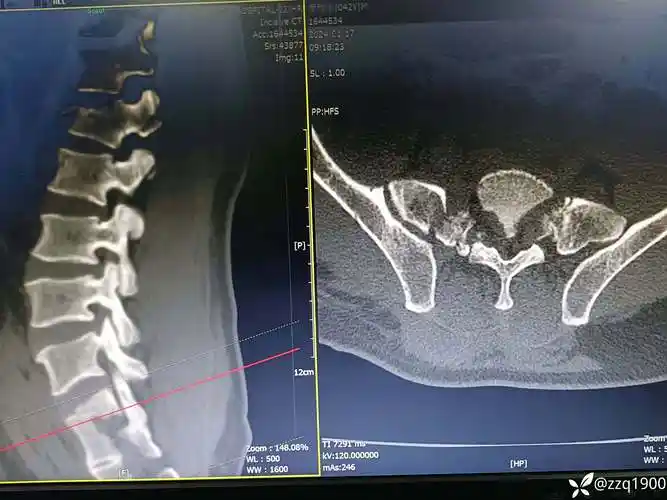 病例分享腰椎骶骨骨折如何处理