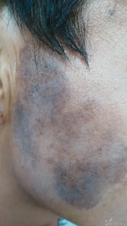 患者半年前发现双侧面颊部色素沉着.逐渐增大.不痛不痒.