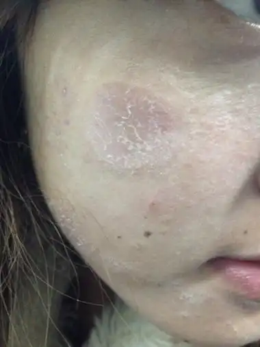 脸上长癣图片 (14)_有来医生