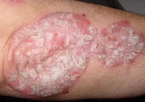 斑块型银屑病长什么样及早期症状图片_银屑病求医网