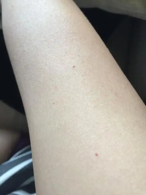 手臂上这小红血点怎么回事,有很久了