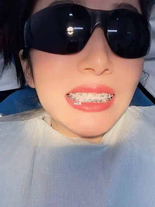 终于摘了我带了快3年的牙套