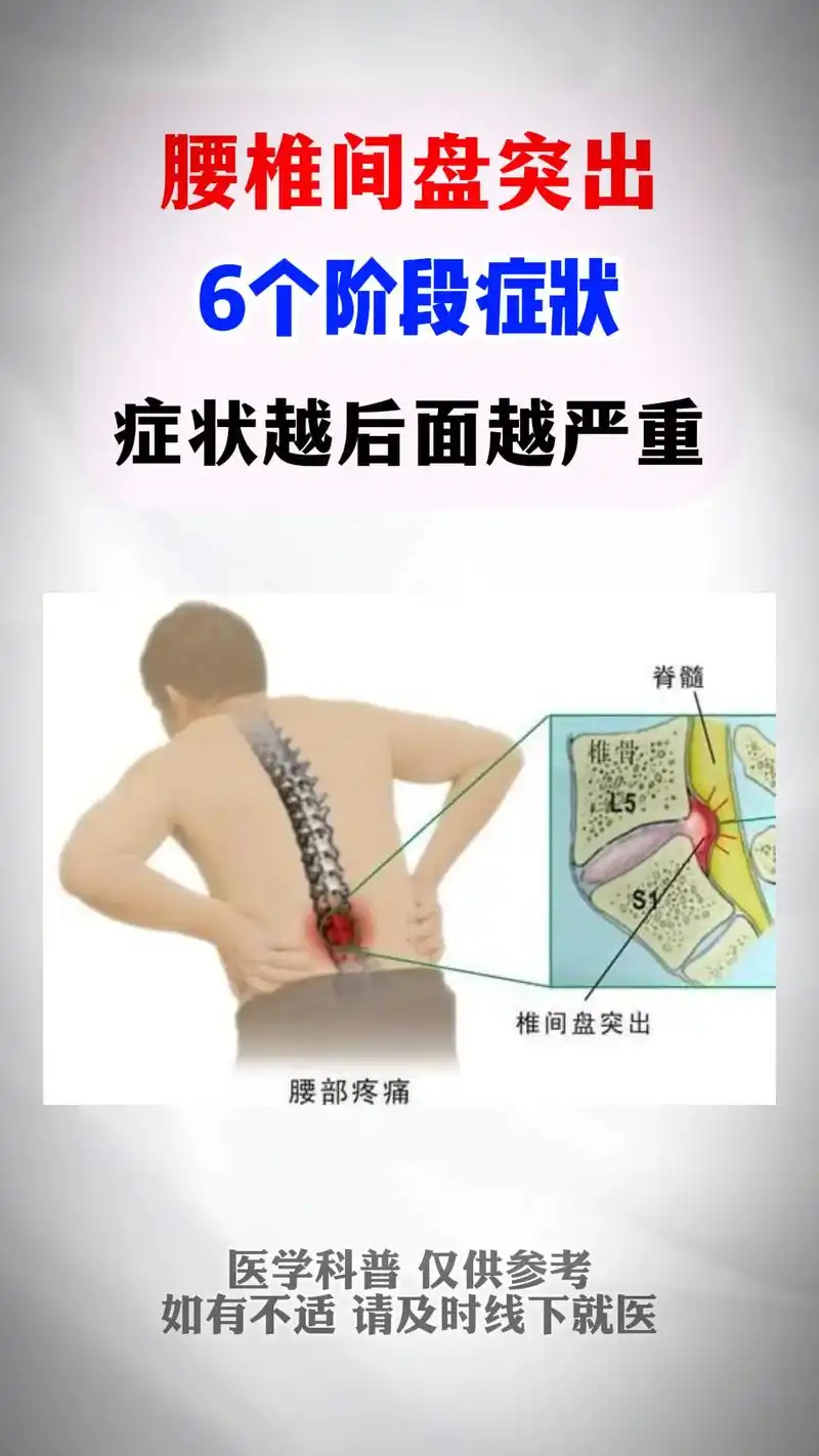 医学科普 #硬核健康科普行动 #健康科普 ##腰椎间盘突 - 抖音