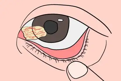 眼底息肉症状图片