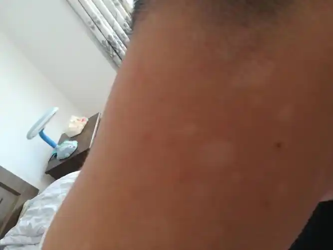 这脖子上的白斑是什么