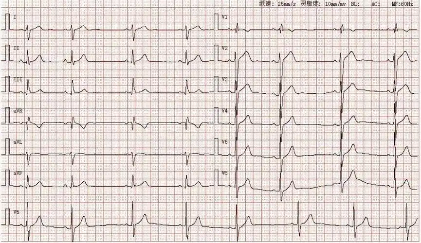 心电图图库丨完全性右束支阻滞系列