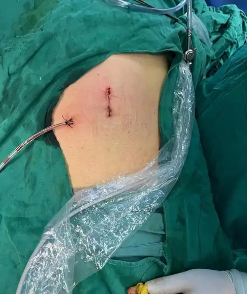 技术革新新术式一次完成二侧肾囊肿手术