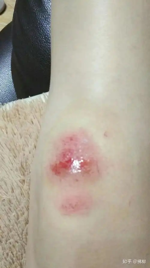 膝盖磕伤 - 知乎