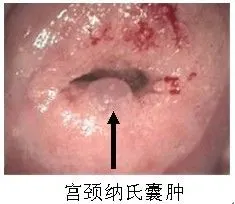 慢性宫颈炎分类图片