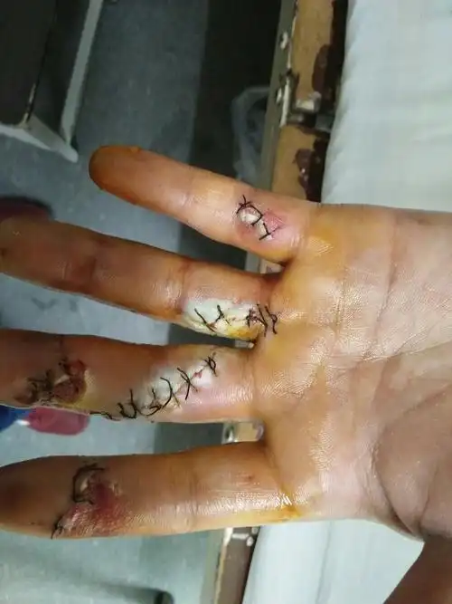 小心干活时手被压面机压到了导致四个手指尖都是粉碎性骨折(不算拇指