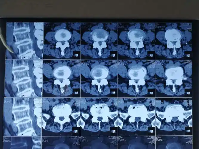 腰45极外侧突出?