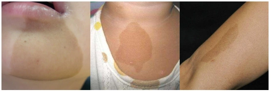 这种斑宝宝身上超过6个就要注意了原创