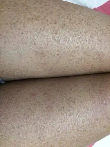 超级急,我身上有黑色的小斑一样,看着恶心,以前只要小腿有,现在全身都