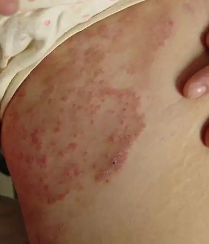 尤立平主任医师谈:股癣(一种容易误治的皮肤病)