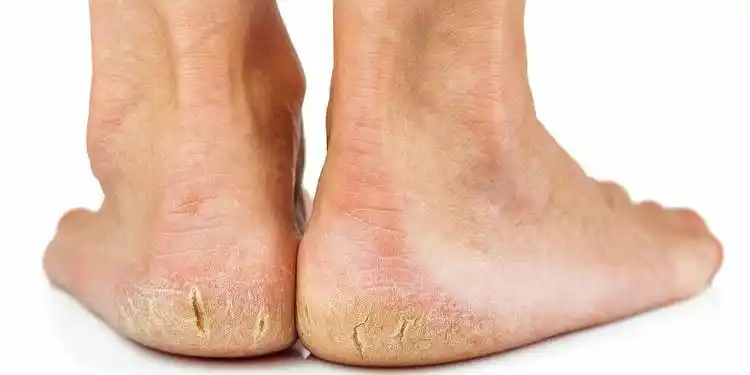 脚后跟脱皮裂口不用急,教你一个老办法,轻松解决,好用又省钱