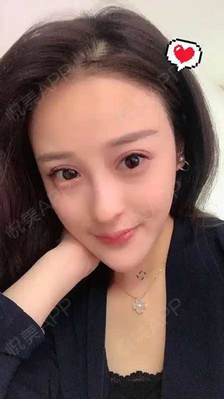 韩式双眼皮术后65天_全切双眼皮术后65天_眼综合术后65天_隆鼻术后65