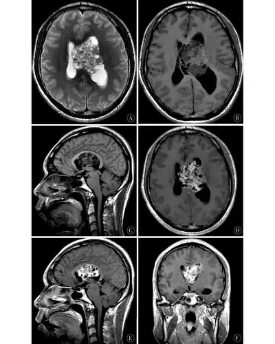 可见典型的" 丝瓜瓤症", 其内可见多个斑点状更长t 2信号影;b,c:轴位