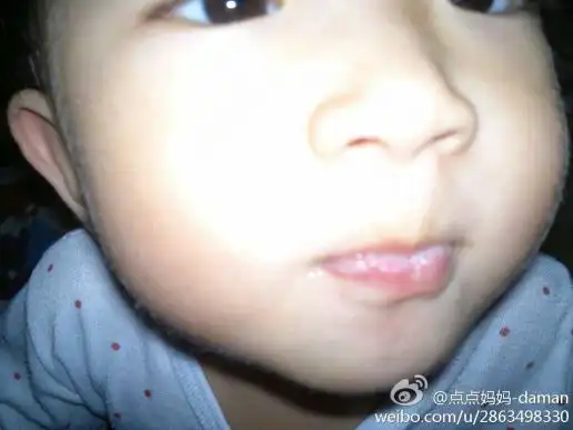 请问这是什么,我家宝宝前两天开始嘴唇上长了些白斑?