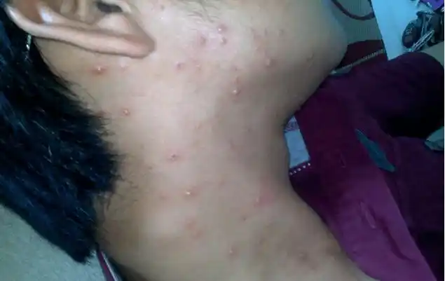 因此一旦发现孩子出水痘,各方面都要特别注意,积极治疗缓解症状并让